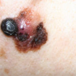 Superficiálně se šířící melanom